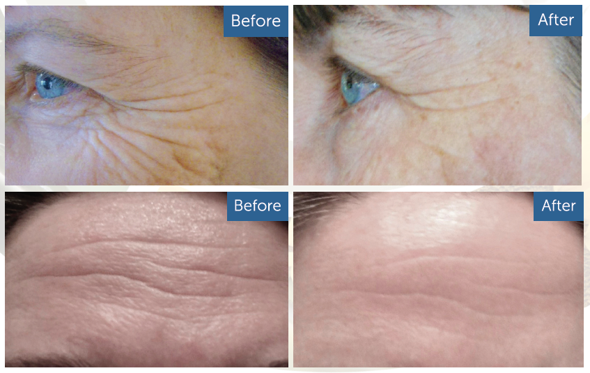 best cream for forehead wrinkles
